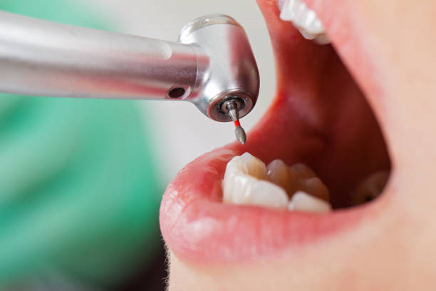 Best Emergency Wisdom Teeth Removal in Duncansville, PA